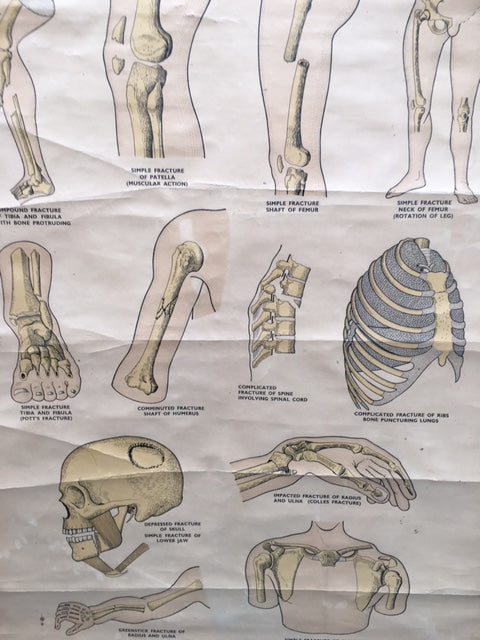 Original Cool vintage “ first and fracture chart medical poster